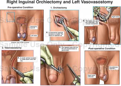 Delhi India, Low Cost Total Orchiectomy Mumbai India,, Affordable Healthcare India