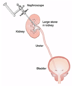 PCNL Surgery India offers info on Cost PCNL Surgery Hospital India, PCNL Care In India, Percutaneous Nephrolithotomy Surgery India