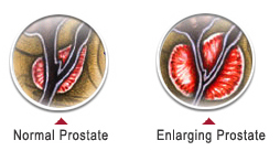 TTrans Vaginal Tape Surgery India, Cost Trans Vaginal Tape Surgery India, Hospitals In India