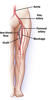 Arterial Bypass Surgery India Cost Coronary Artery Bypass Surgery Cabg