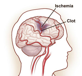 Thrombolytic Therapy India offers info on Cost Thrombolytic Therapy India, Thrombolytic Therapy India