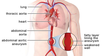 Abdominal Aortic Aneurysm Treatment offers info on Abdominal Aortic Aneurysm Surgery India