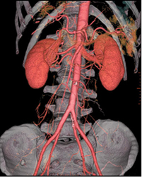 Aortic Aneurysm Repair India, Safe Aortic Aneurysm Repair India, Aortic Aneurysm India, Surgical Treatment Of Disease India