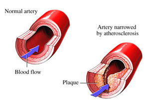 Peripheral Vascular Surgery offers info on Peripheral India, Peripheral Vascular India, Vascular Surgery India, Peripheral Vascular Surgery India