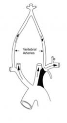 Subclavian Steal Syndrome Treatment offers info on Subclavian Steal Syndrome India, Subclavian India